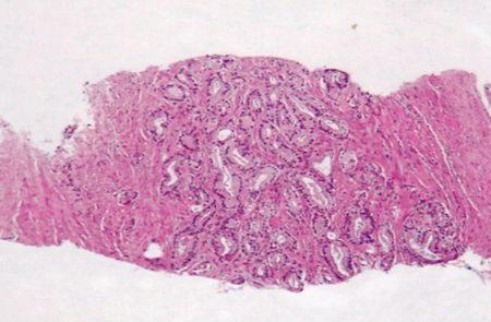 Obiecująca terapia pomoże w nowotworze prostaty?